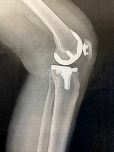 knee X-ray after robotics-assisted procedure
